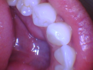 intraoral dental camera